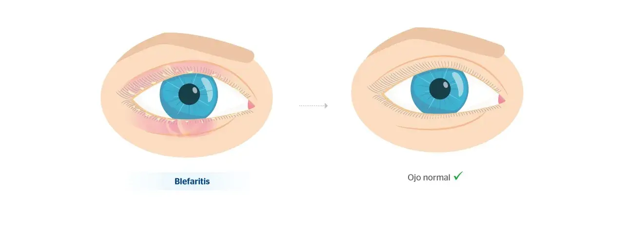 Ojo con blefaritis, inflamado y con secreción, evoluciona a un ojo normal.