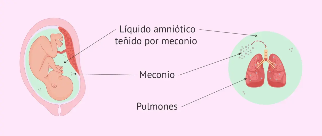 Feto en útero, líquido amniótico teñido por meconio, y pulmones fetales con partículas de meconio. La primera caca del bebé, el meconio, puede afectar los pulmones.