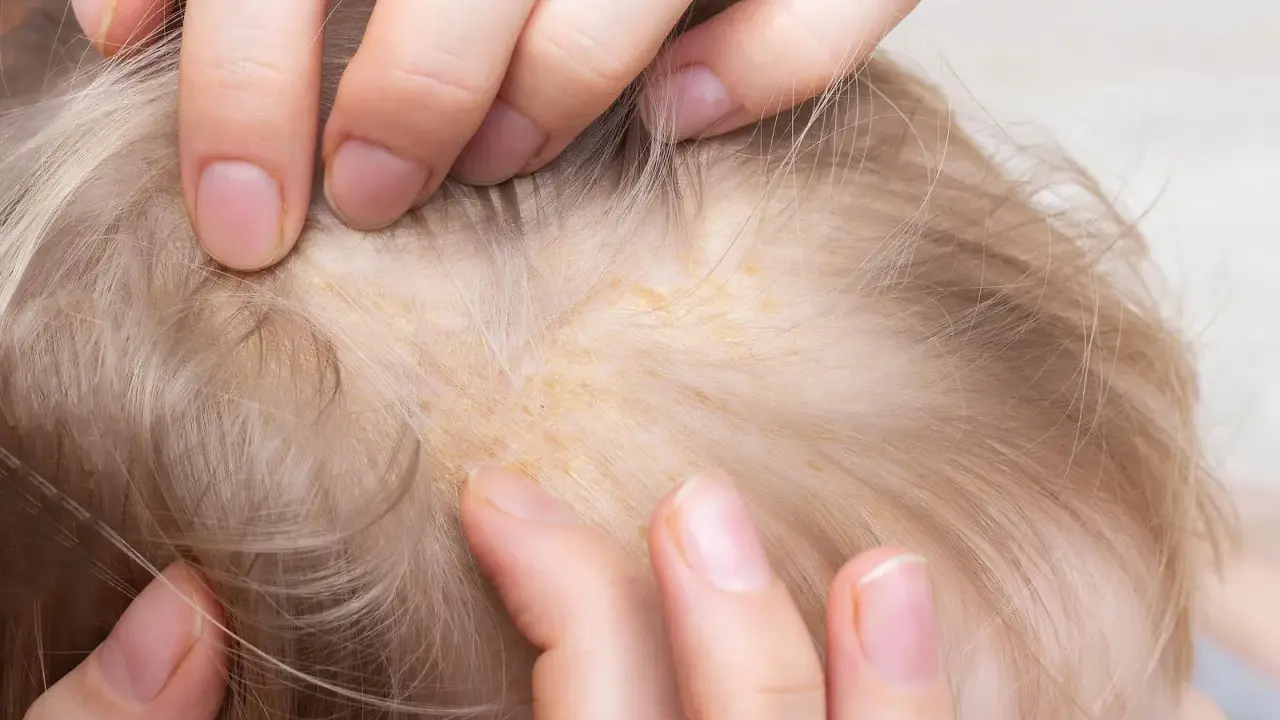 Manos separan el cabello rubio de un bebé, revelando escamas amarillentas en el cuero cabelludo, similar a la caspa en las orejas.