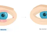 Ojo con blefaritis, inflamado y con secreción, evoluciona a un ojo normal.