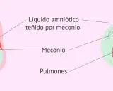 Feto en útero, líquido amniótico teñido por meconio, y pulmones fetales con partículas de meconio. La primera caca del bebé, el meconio, puede afectar los pulmones.
