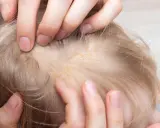 Manos separan el cabello rubio de un bebé, revelando escamas amarillentas en el cuero cabelludo, similar a la caspa en las orejas.