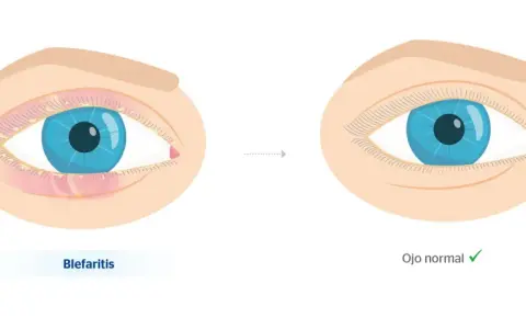 Ojo con blefaritis, inflamado y con secreción, evoluciona a un ojo normal.