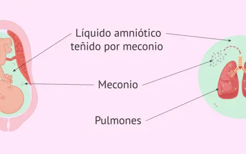 Feto en útero, líquido amniótico teñido por meconio, y pulmones fetales con partículas de meconio. La primera caca del bebé, el meconio, puede afectar los pulmones.