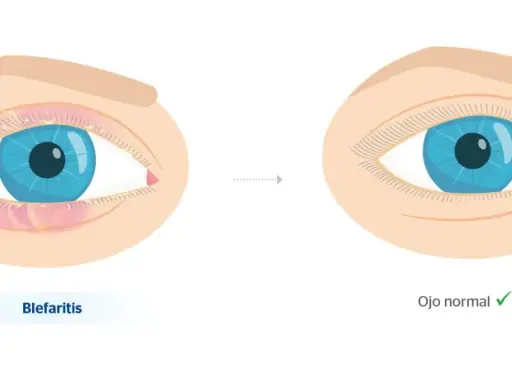Ojo con blefaritis, inflamado y con secreción, evoluciona a un ojo normal.