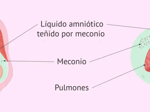 Feto en útero, líquido amniótico teñido por meconio, y pulmones fetales con partículas de meconio. La primera caca del bebé, el meconio, puede afectar los pulmones.
