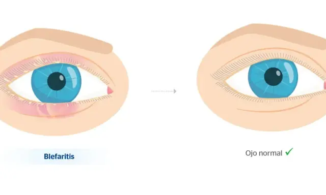 Ojo con blefaritis, inflamado y con secreción, evoluciona a un ojo normal.