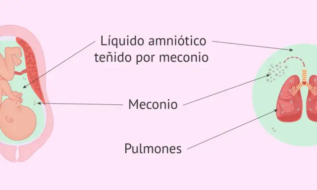 Feto en útero, líquido amniótico teñido por meconio, y pulmones fetales con partículas de meconio. La primera caca del bebé, el meconio, puede afectar los pulmones.