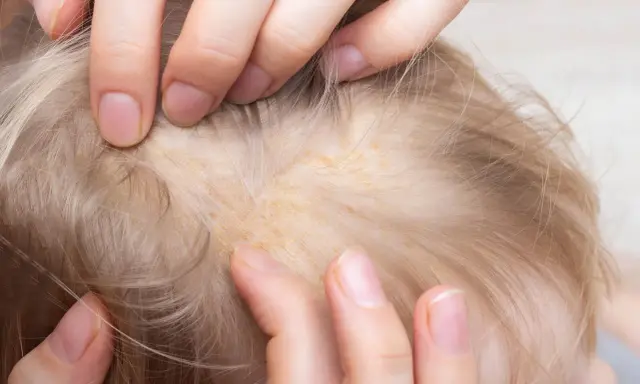 Manos separan el cabello rubio de un bebé, revelando escamas amarillentas en el cuero cabelludo, similar a la caspa en las orejas.