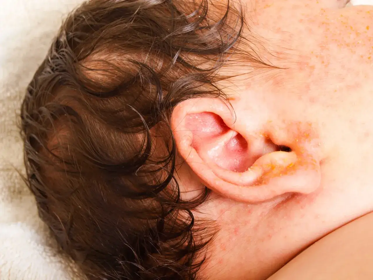 Primer plano de la oreja de un beb&eacute; con signos de eczema, mostrando piel irritada y escamas amarillentas.